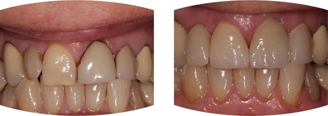 Before and after dental treatment images for Emax Porcelain Veneers