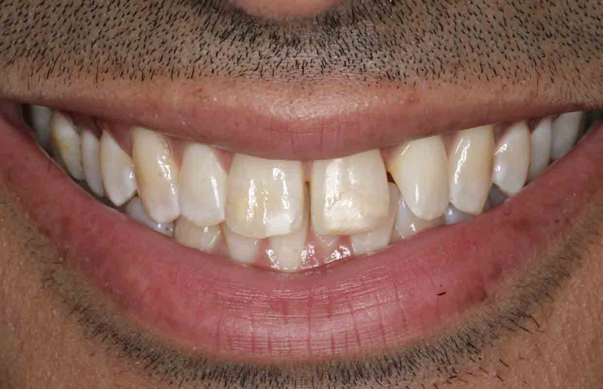 Before dental treatment photo of dental composite tooth repair.