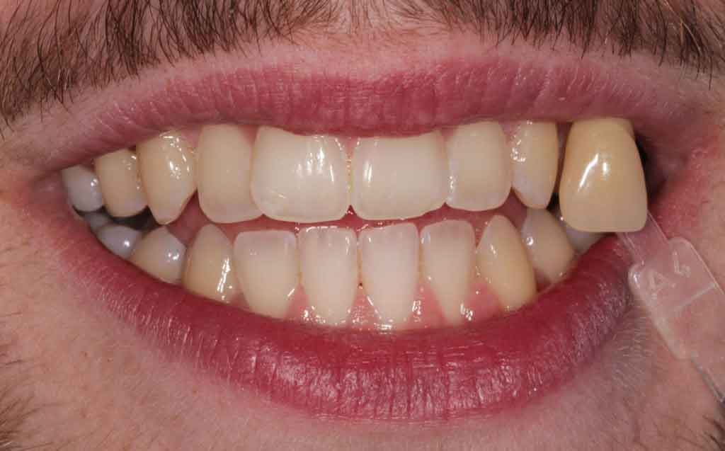before-enlighten-teeth-whitening-image