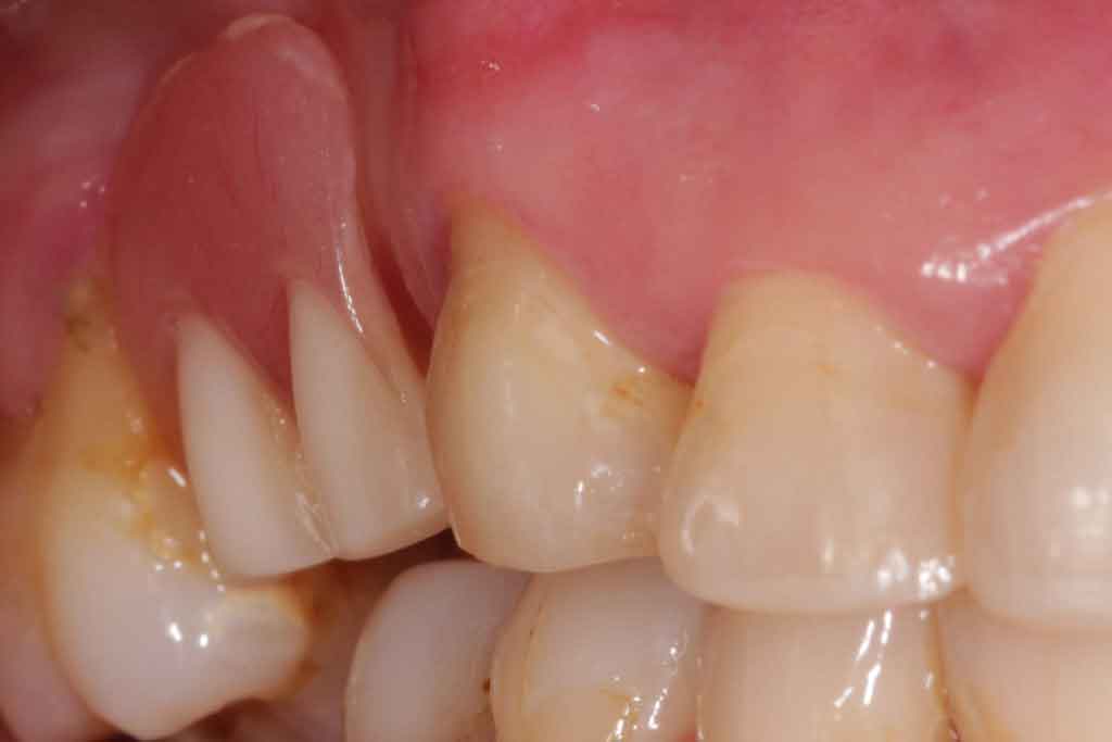 How-to-remove tartar-from-teeth-without-dentist-intervention