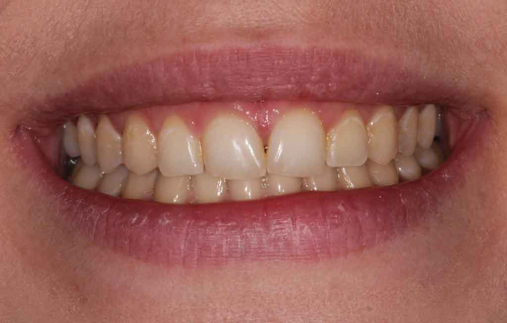 before-teeth-whitening-image