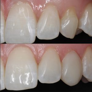 invisalign-teeth-whitening-composite