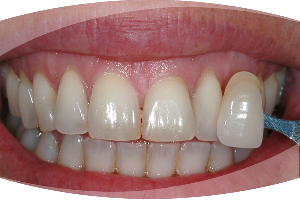 Photo before Enlighten Teeth Whitening Treatment