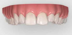 cosmetic-dentistry-using-Invisalign-and-composite-bonding