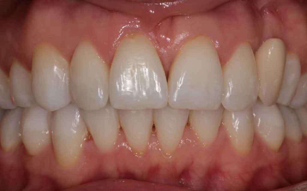 after-invisalign-treatment-image
