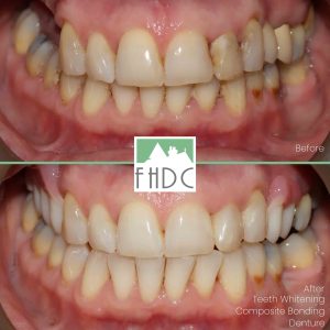 dentist-whitening-bonding-denture-before-and-after