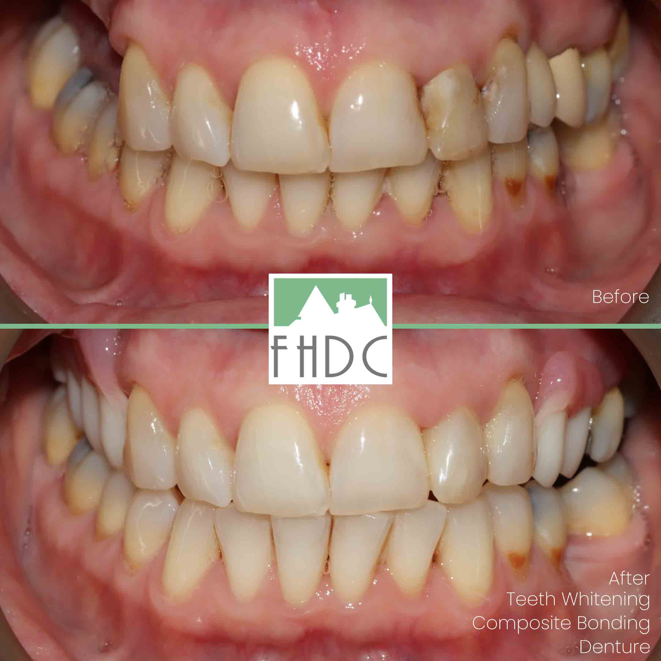 whitening-bonding-denture-before-and-after