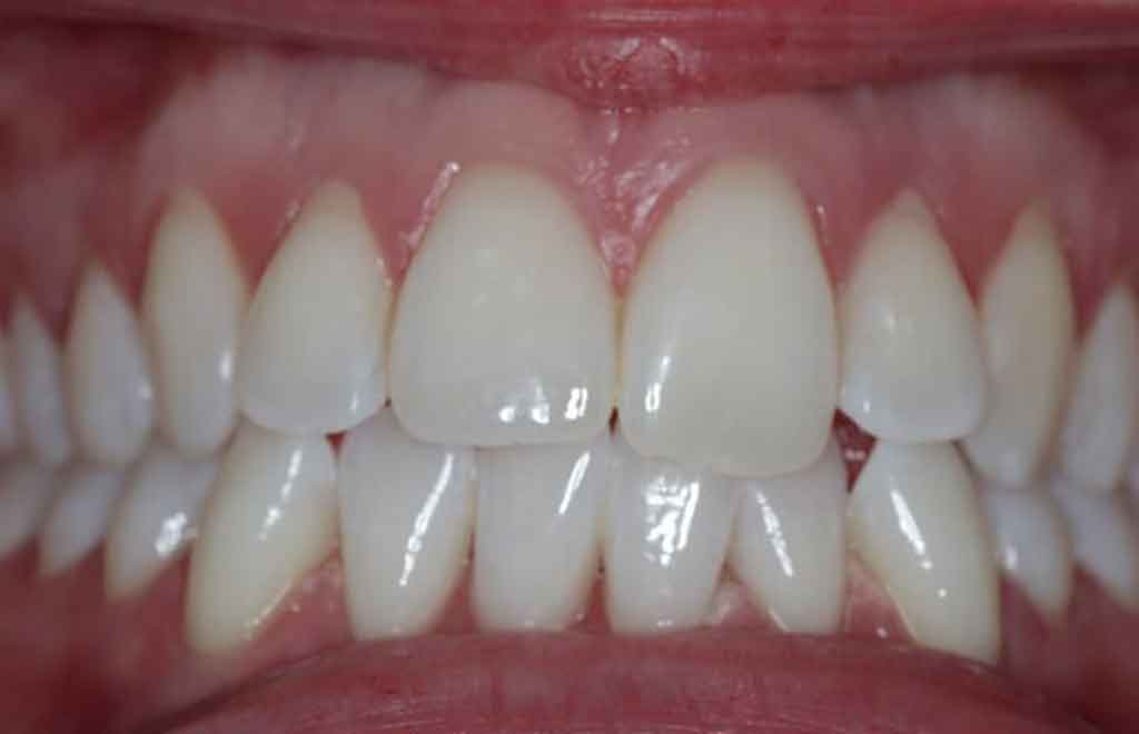 after-image-enlighten-teeth-whitening