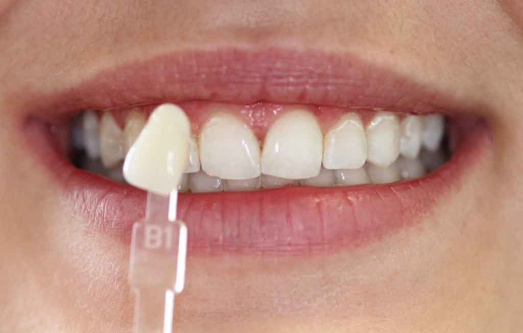 b1-teeth-whitening-after-treatment