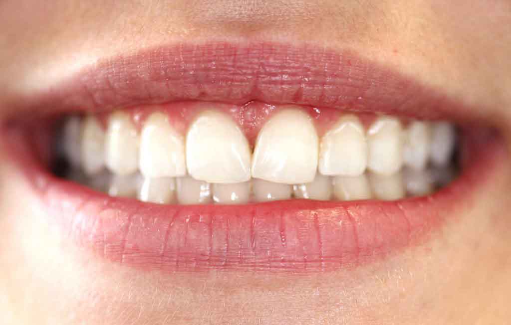 delighted-teeth-whitening-client-after-treatment