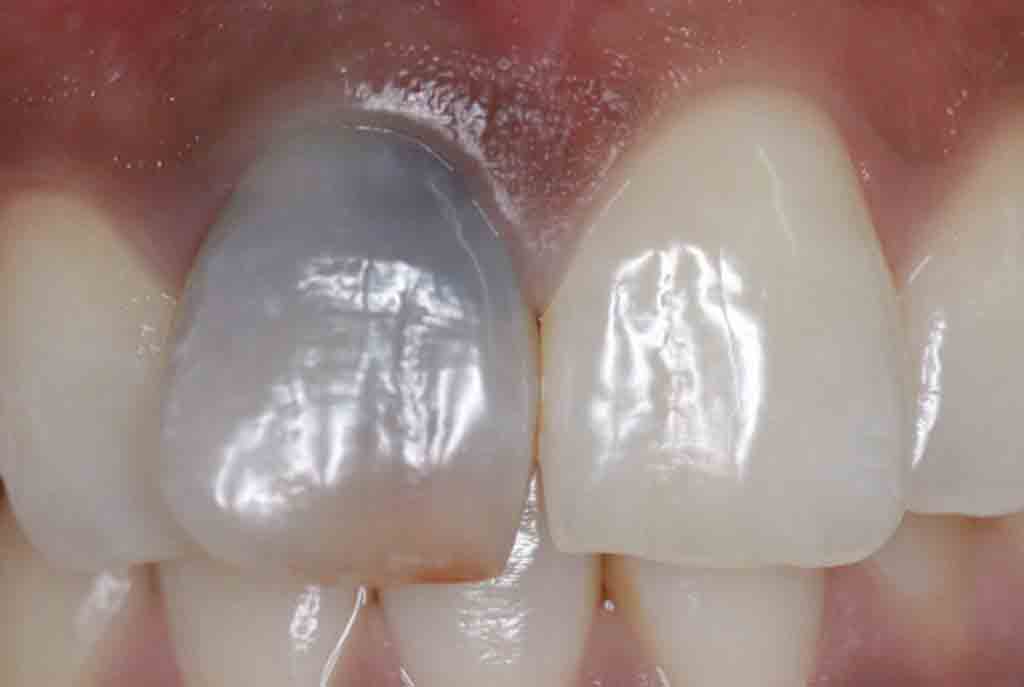 before-internal-tooth-whitening-image