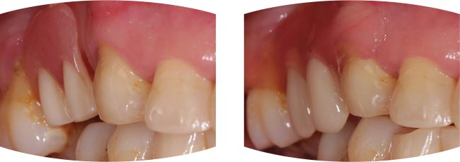 Valplast Dentures case study