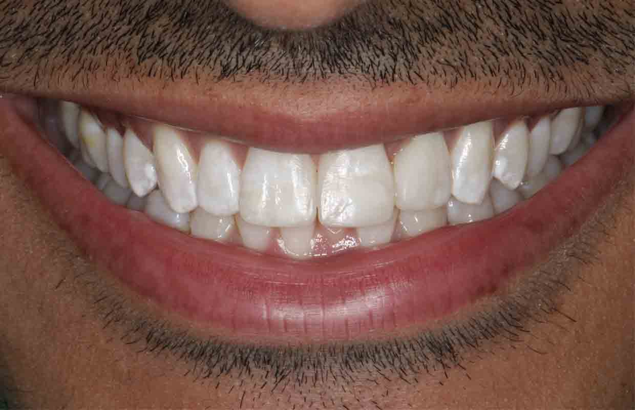 After dental treatment photo of teeth whitening and composite bonding dental treatment.